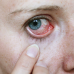 Ögoninflammation (konjunktivit): symtom & behandling